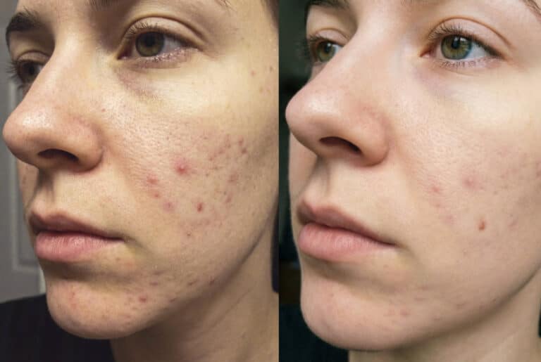 Photo de témoignage client montrant un visage avant et après l’utilisation de soins au lait de chèvre Savon d’Ardèche