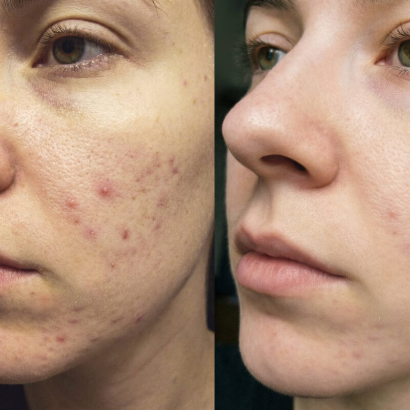 Photo de témoignage client montrant un visage avant et après l’utilisation de soins au lait de chèvre Savon d’Ardèche